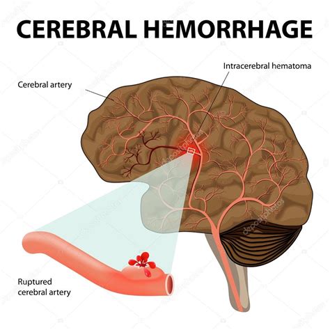 Cerebral hemorrhage — Stock Vector © edesignua #53194819