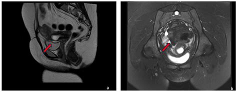 MRI Assessment of Cesarean Scar Pregnancies: A Case Series