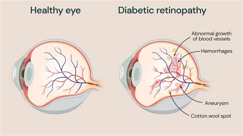 Diabetic retinopathy - Guys and St Thomas Specialist Care