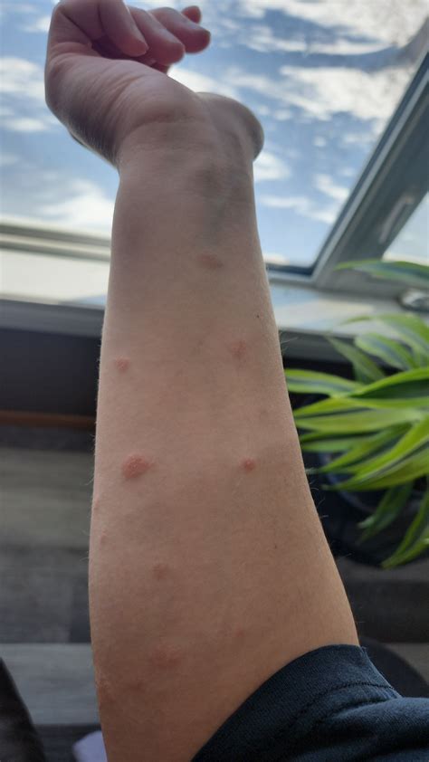 Is this pityriasis Rosea or psoriasis? Doctors aren't giving direct response and they won't ...