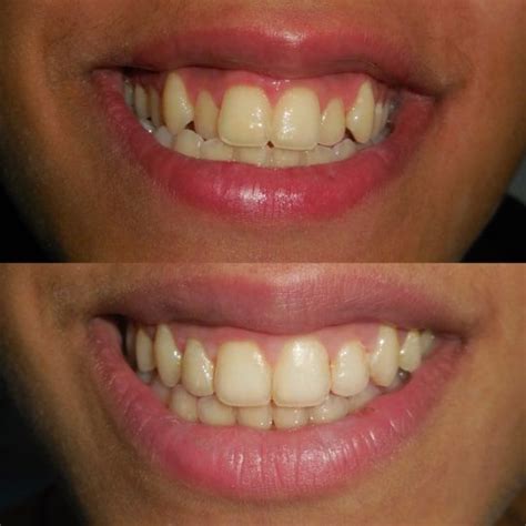 Ceramic Braces Treatment in Nepean sea road |Best Ceramic Braces in ...