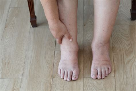 Poor circulation: throw the kitchen sink at it | Foot Problems?