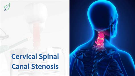 Grade 1 Cervical Spinal Stenosis: Causes Symptoms And Treatment – CVYBIK