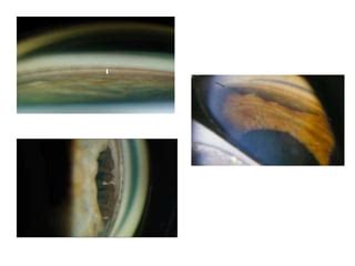 Angle Recession 的图像结果