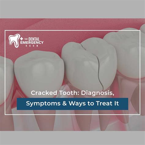 Cracked Tooth: Diagnosis, Symptoms & Ways to Treat It
