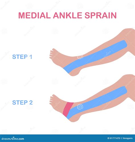 Taping Ankle Deltoid Ligament at Luke Cornwall blog