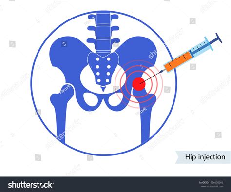 Cortisone Injections For Hip Bursitis at Tammy Teague blog