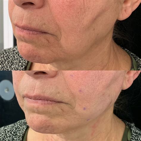 Non-surgical Jowl Lift | Jowl Treatment to Tighten Jowls, Filler for Jowls