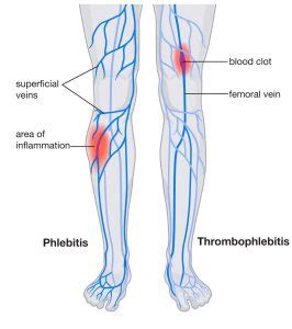 Superficial thrombophlebitis can pose grave health risks