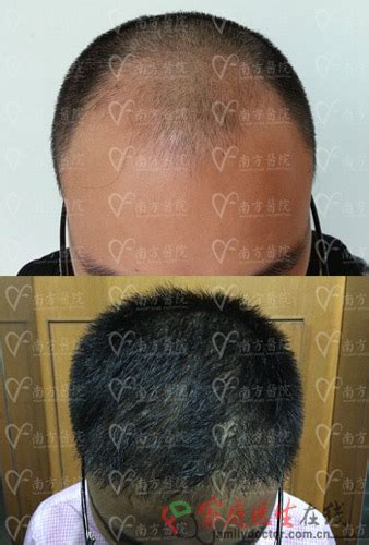 毛发种植“取材”很重要 后脑勺头发最健康_家庭医生在线整形频道