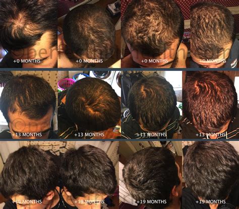 What Causes Hair To Become Thinner at Sophie Denny blog