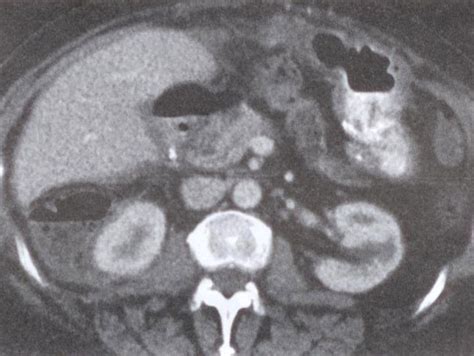 双侧肾周包膜下大量积液：超声 CT及治疗 - 丁香园