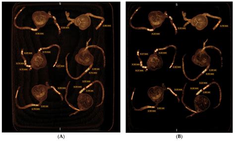 3D-Printed Coronary Plaques to Simulate High Calcification in the Coronary Arteries for ...