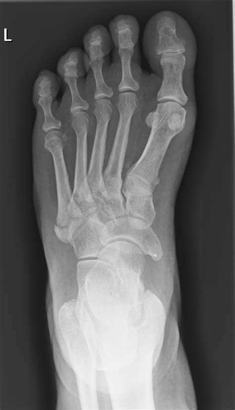 Avulsion Fracture 5Th Metatarsal Xray at Jose Watson blog