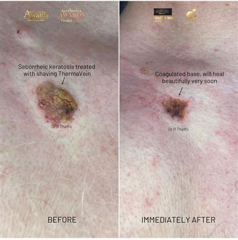 Aesthetic treatment results gallery | Yorkshire Skin Centre