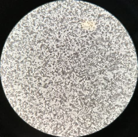 Crystals In Urine Amorphous Urates at James Loman blog