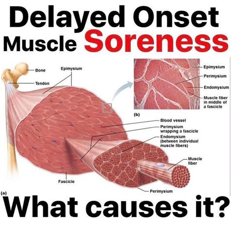 Top Notch Info About How To Get Rid Of Muscle Soreness After A Workout - Musictune43