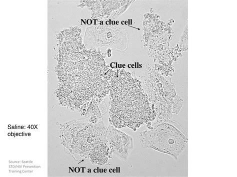 PPT - Vaginitis & Pelvic Inflammatory Disease PowerPoint Presentation ...