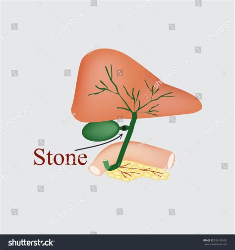 Stone Bile Duct Gallbladder Duodenum Pancreas Stock Illustration 326158130