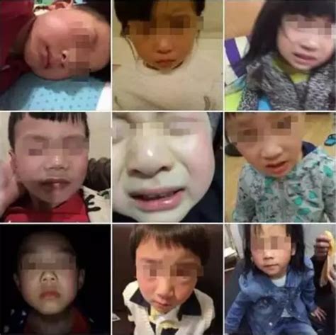30多名孩子眼睛被灼伤，这5种“光”一定要小心！__小豆苗疫苗助手