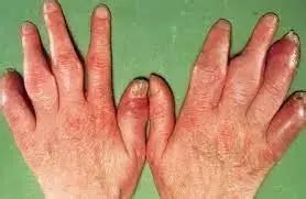 Dactylitis tied with higher disease burden in early psoriatic arthritis ...