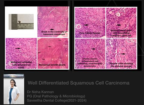 Well Differentiated Squamous Cell Carcinoma — ORAL PATHOLOGY-SAVEETHA