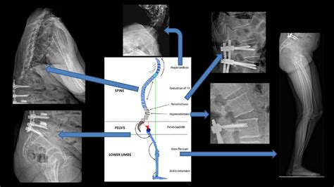 Image result for Compensatory Acceleration