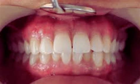 Adult Gingival Cyst with Marked Gingival Hyperplasia: A Rare Case Report