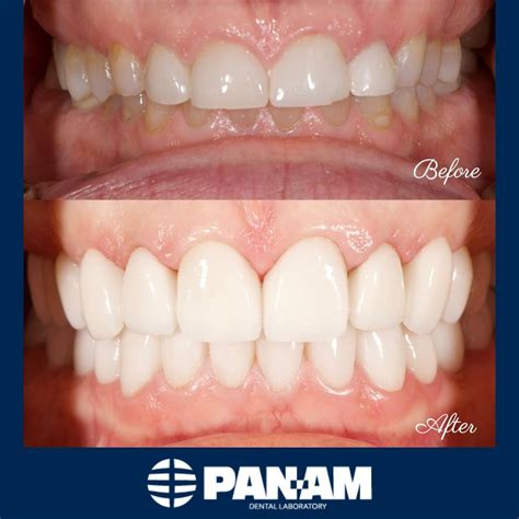 Pan-Am Dental Laboratory on LinkedIn: #panamdental #dentallab