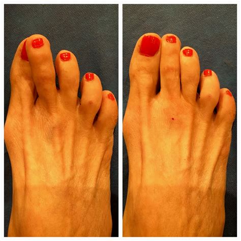 Hammertoe Tendon Release - 26 Foot & Ankle
