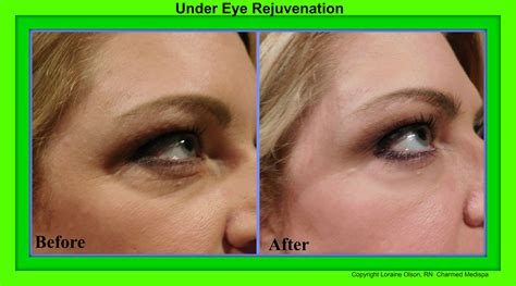 Under Eye Rejuvenation without Surgery – Charmed Medispa