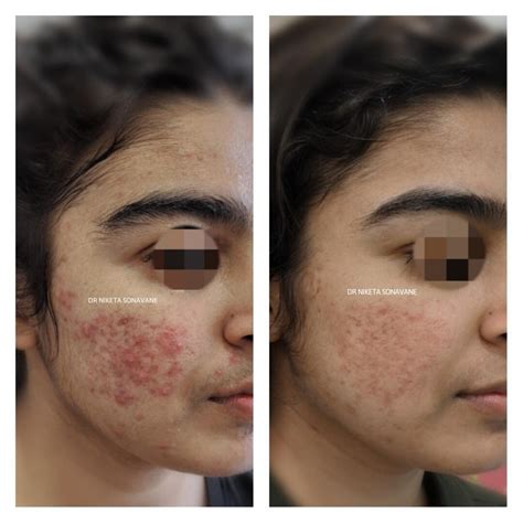 Acne Scars Before And After Chemical Peel