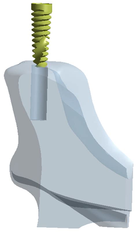 Exploring Stresses in Mandibular Jawbone during Implant Insertion: A ...