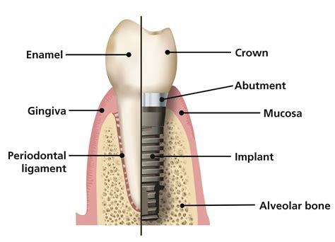 Dental implants | Prevention and Treatment of Periodontal Diseases in Primary Ca
