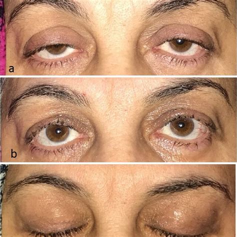 Image result for Levator Resection Surgery