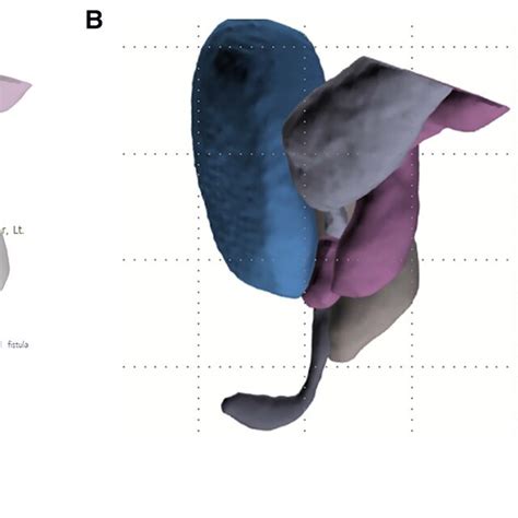 Image result for Distal Loopogram