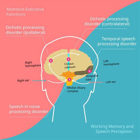 Image result for Auditory Processing Disorder