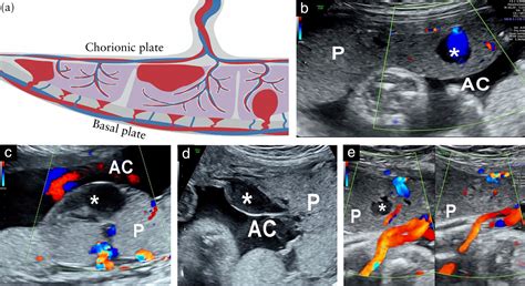 Placental lakes vs lacunae: spot the differences - Jauniaux - 2024 ...
