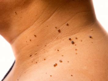 Skin Tag & Mole Removal | M A Skin & Hair Superspeciality Clinic - Dr ...