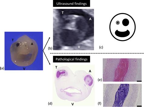 Umbilical Artery Ultrasound