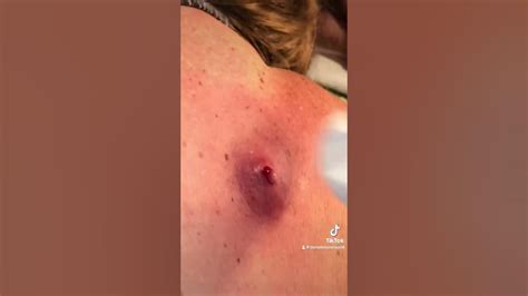 Largest Exploding Cyst 的图像结果