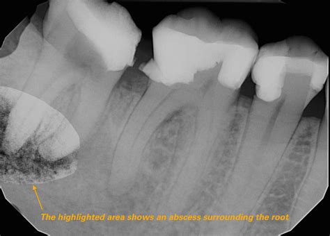 Abscessed Tooth Xray