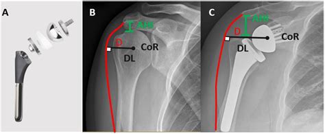 How Common Is Reverse Shoulder Replacement at Lawrence Melson blog