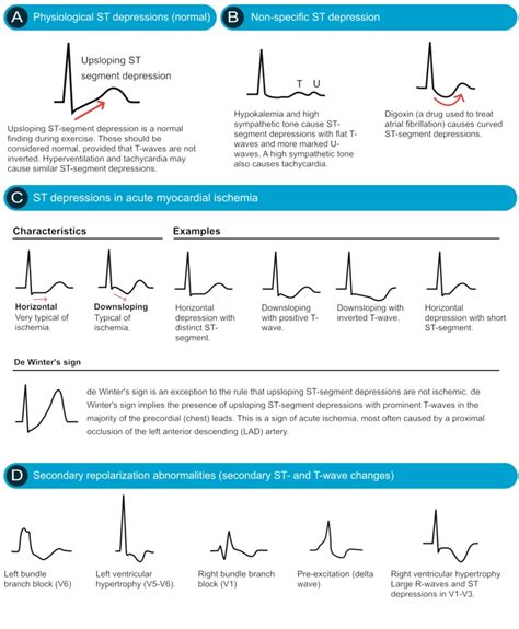 Image result for ECG Examples