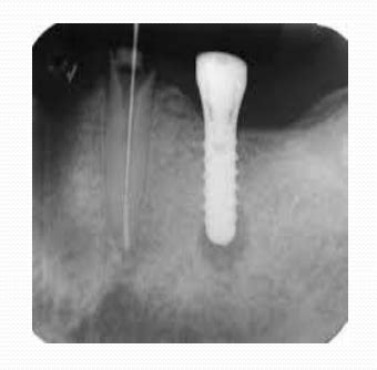 Image result for Two Walled Defect Perio