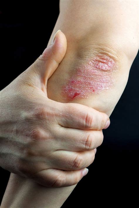 psoriasis rash photos