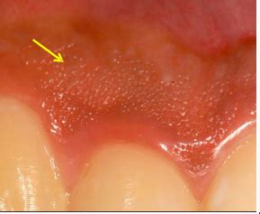 Image result for Two Walled Defect Perio