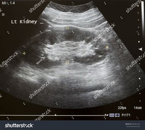 Normal Left Kidney Ultrasound