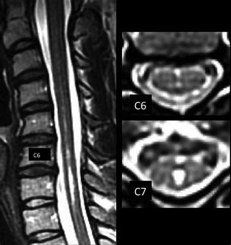MRI T2-Hyperintense Signal Structures in the Cervical Spinal Cord ...
