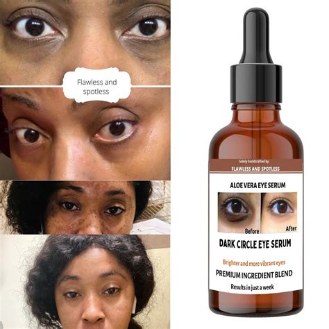 Under Eye Serum Dark Circles at Veronica Bartley blog
